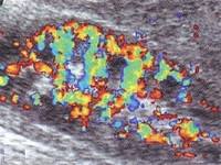 Дуплексное сканирование почечных артерий и вен