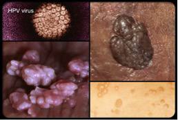 Вирус папилломы человека и рак шейки матки